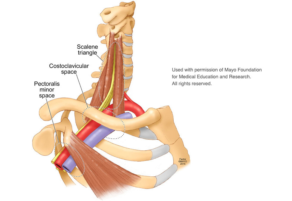 What is Thoracic Outlet Syndrome? | The Cherington Practice